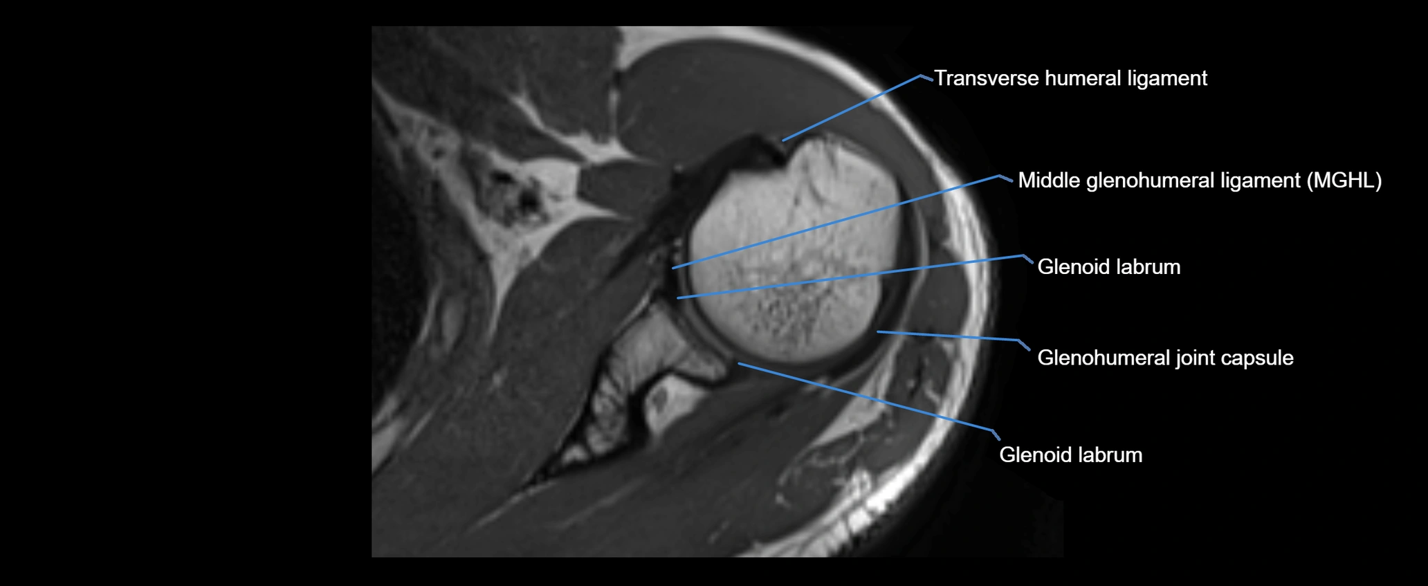 shoulder ligaments axial 3d 3t mri image-img-00005-00058.webp